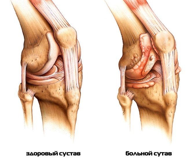 Хвороби колінного суглоба: які бувають?