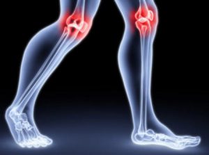 Хрускіт в колінах при присіданні: причини, як позбавитися, лікування, профілактика