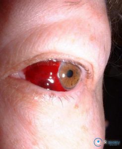 Кров з очей: чому вона йде і які причини можуть викликати