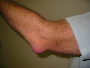 Болить ліктьовий суглоб правої руки: чим лікувати, що робити