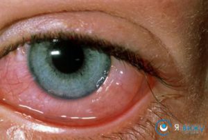 Хвороби повік очей нижнього, верхнього (фото, лікування)