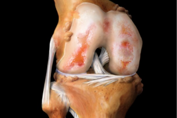 Як лікувати артроз колінного суглоба медикаментозне лікування