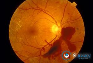 Діабетична ретинопатія: причини виникнення, симптоми, діагностика, лікування