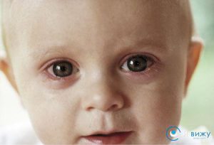 Почервонів очей у дитини: причини та фактори, що викликають такий стан