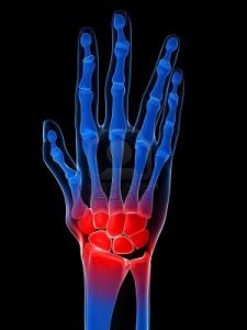 Лікування артриту пальців рук у домашніх умовах: перші симптоми, медикаменти, дієта, народні засоби