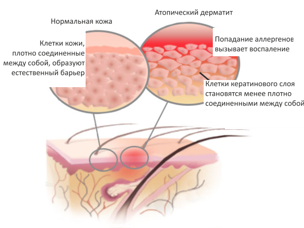 Причини і симптоми атопічного дерматиту у новонародженого