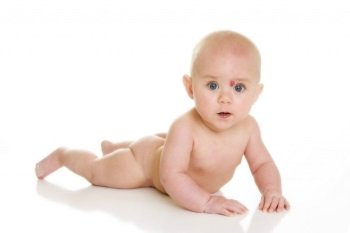 Причини появи родимих плям у немовлят