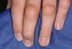 Болять суглоби на пальцях рук: чим лікувати і які причини