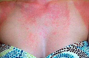 Алергія на сонце що робити?