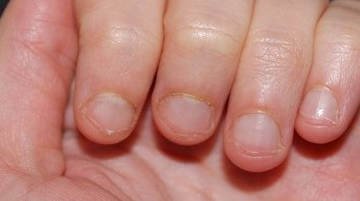 Перевірені способи швидко перестати гризти нігті на руках