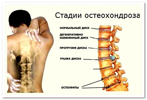 Добірка вправ при остеохондрозі – здорова спина і шия