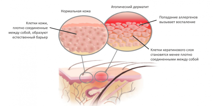 Алергічна висипка на тілі дитини: види шкірних висипань з фото і схемами лікування