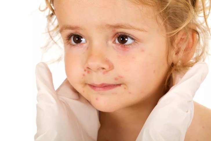 Як лікувати білі і червоні виразки у роті дитини: медикаментозні засоби і домашні рецепти