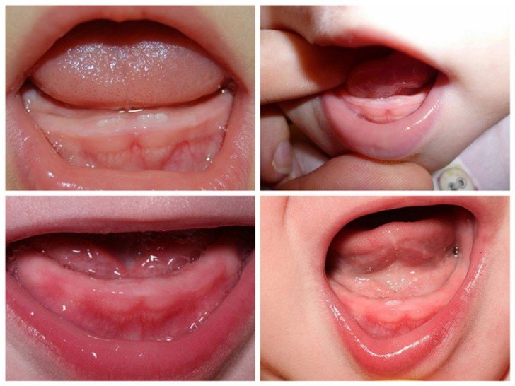 Як виглядають на фото набряклі ясна при прорізування перших зубів у немовлят?
