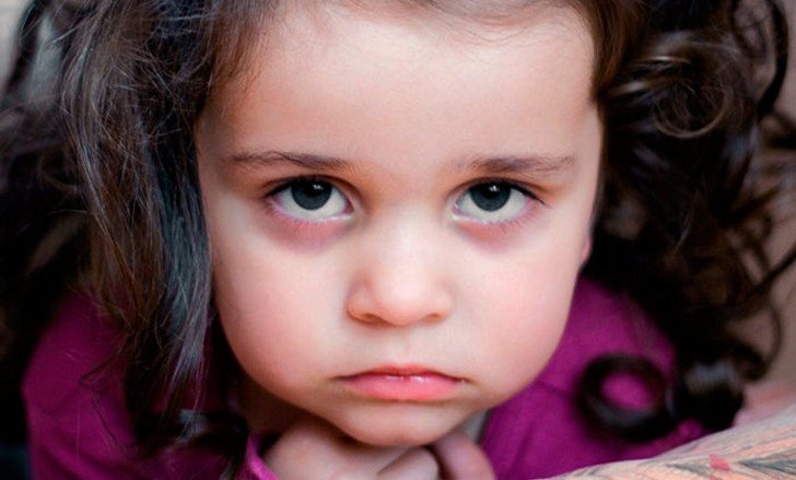 Чому у дитини зявляються синці під очима: причини та способи лікування