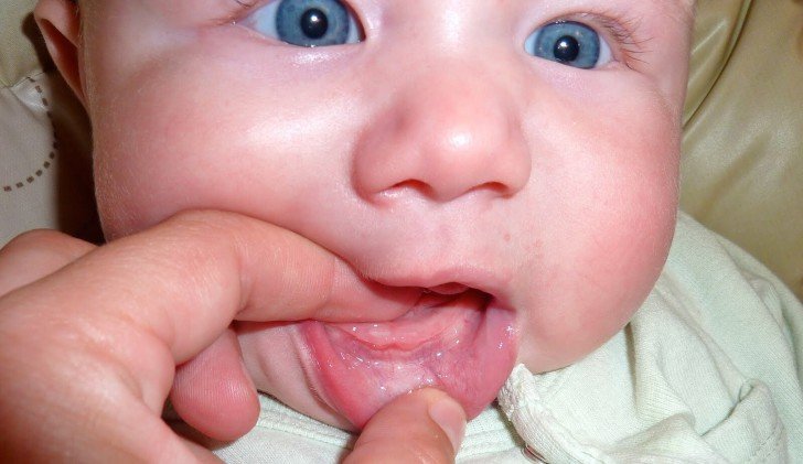 Як виглядають на фото набряклі ясна при прорізування перших зубів у немовлят?