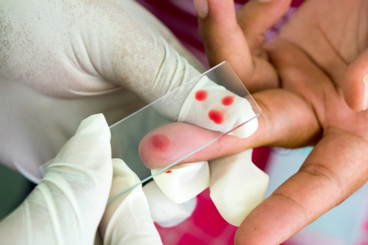 Знижені лімфоцити в крові у дитини — про що це говорить і які причини показників менше норми?