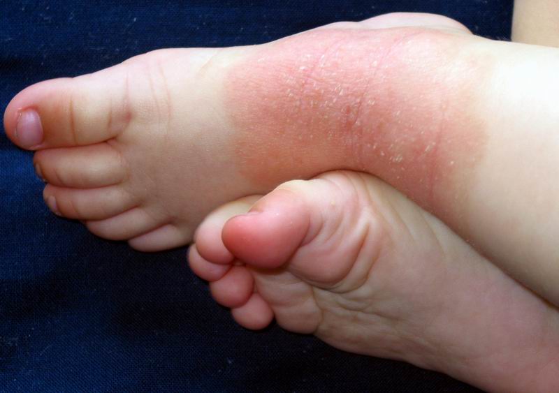 Алергічна висипка на тілі дитини: види шкірних висипань з фото і схемами лікування