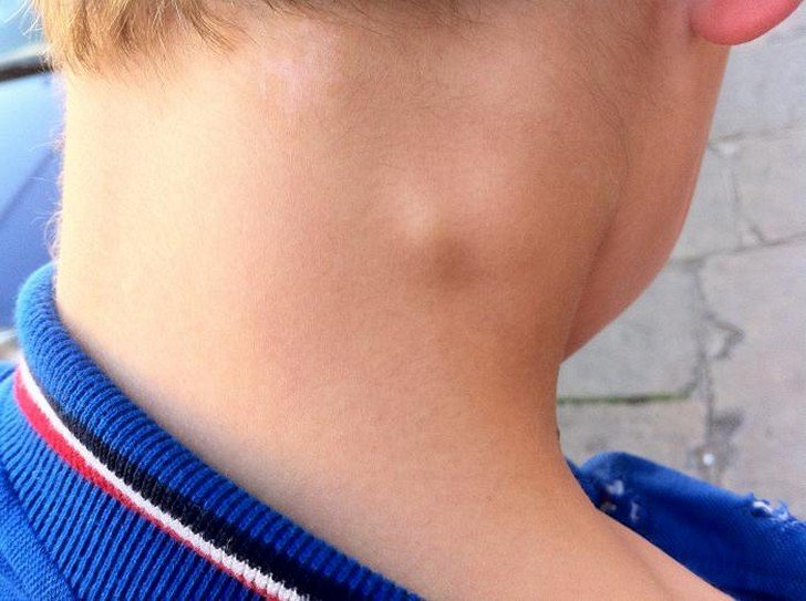 Що означає поява шишки за вухом на кістки у дитини: причини і лікування ущільнень