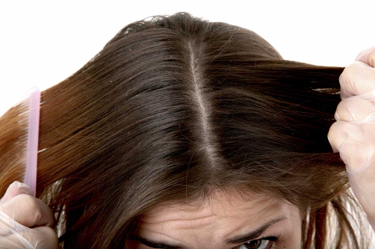 Як позбавитися від лупи і випадання волосся в домашніх умовах швидко і ефективно?