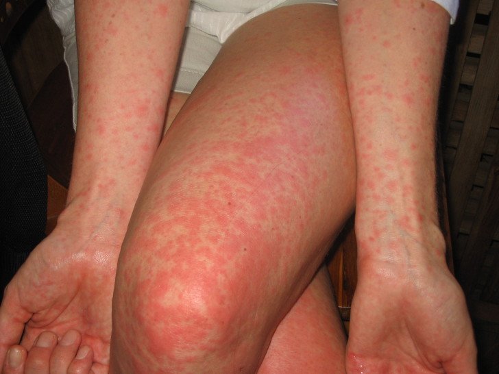 Види висипки у дитини на ногах і ступнях з фото і поясненнями: ознаки алергії і інфекційних захворювань