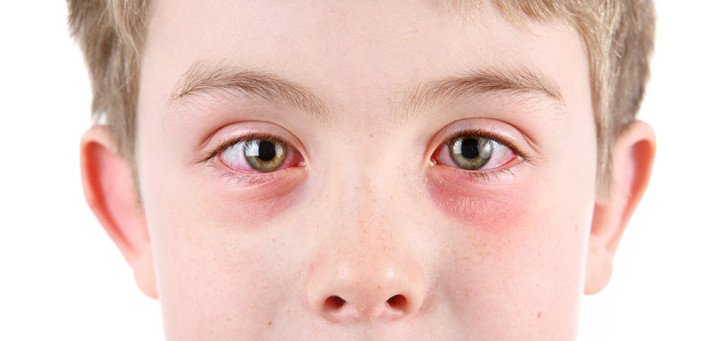 Що робити, якщо у дитини почервоніли очі: причини і лікування, супутні симптоми й профілактика