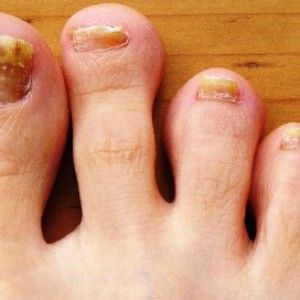 Народні засоби від грибка нігтів на ногах: 7 швидких і дешевих способів позбутися від грибка