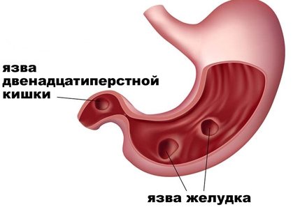 Загострення виразки шлунка: симптоми та лікування Ознаки загострення