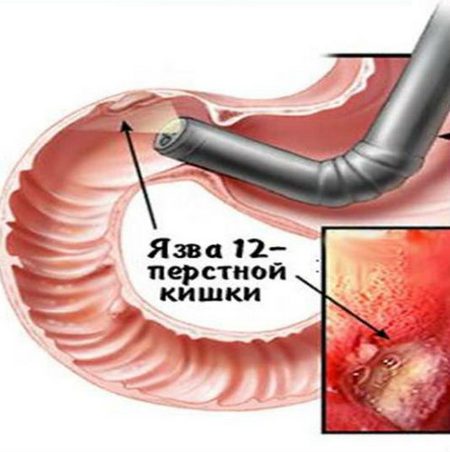 Симптоми виразки кишечника, шлунка та дванадцятипалої кишки