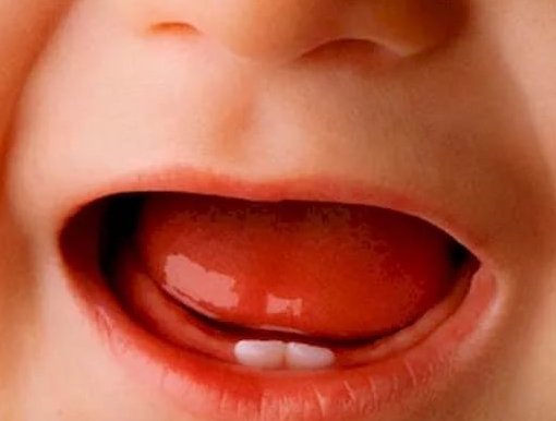 Пронос при прорізуванні зубів у дітей Пронос на зуби у дитини: скільки тримається температура