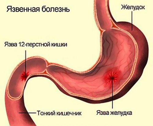 Симптоми виразки кишечника, шлунка та дванадцятипалої кишки
