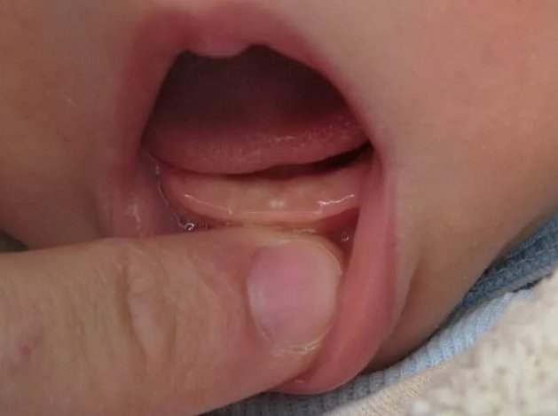 Може бути запор при прорізуванні зубів у дітей і немовляти