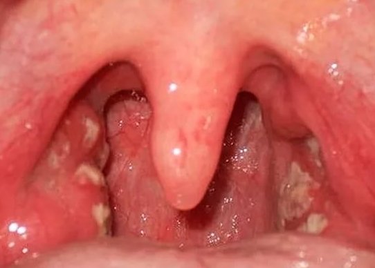 Запах з рота при ангіні і коли хронічний тонзиліт