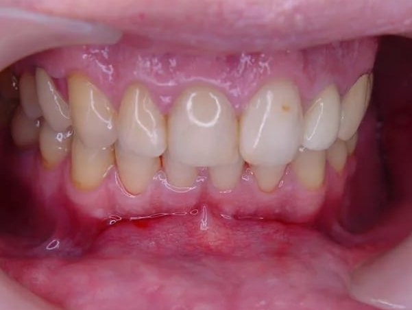 Запалення ясен і неприємний запах з рота Кровоточать ясна і зуби Кровоточивість можна уникнути