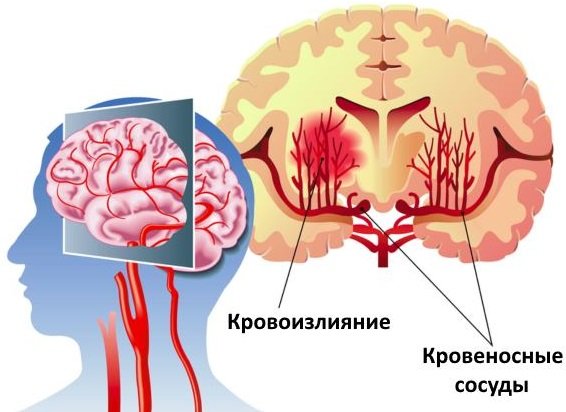 Причини і симптоми струсу мозку, методи лікування