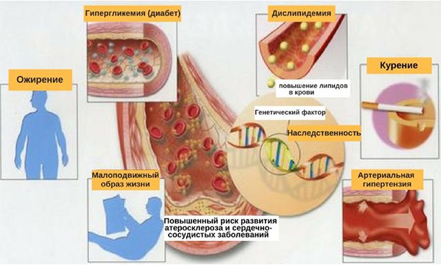 Основні причини і фактори ризику атеросклерозу судин