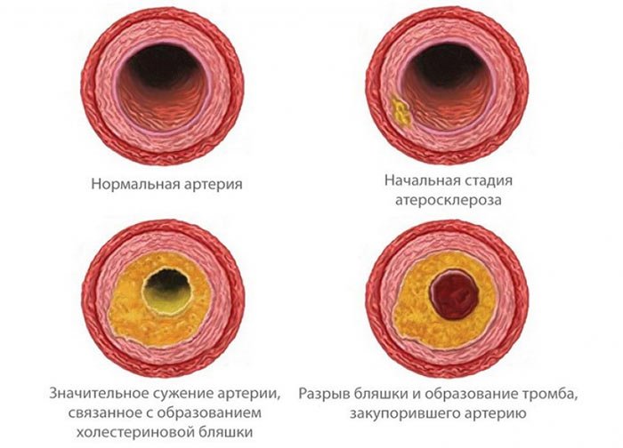 Атеросклероз брахиоцефальных артерій – симптоми і лікування