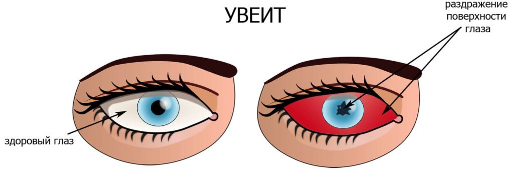 Очний тиск – симптоми і лікування