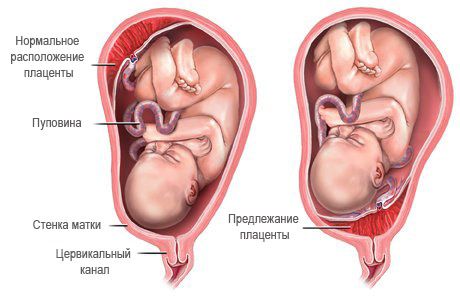 Коричневі виділення при вагітності на ранніх термінах