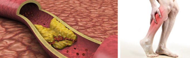 Атеросклероз судин нижніх кінцівок: симптоми і лікування