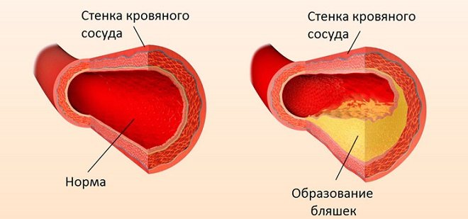 Атеросклероз судин нижніх кінцівок: симптоми і лікування