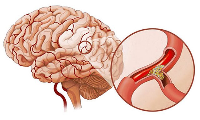Атеросклероз судин головного мозку – симптоми і лікування