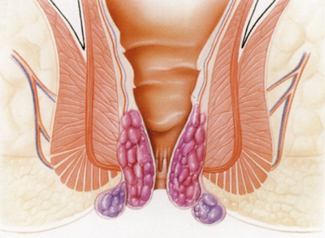 Зовнішній тромбированный геморой: тромбоз або тромбозный