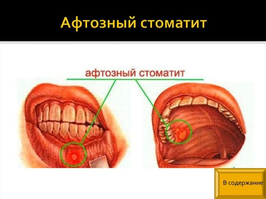 Стоматит у дітей в роті: симптоми, лікування в домашніх умовах афтозного та герпетичного стоматиту + ФОТО
