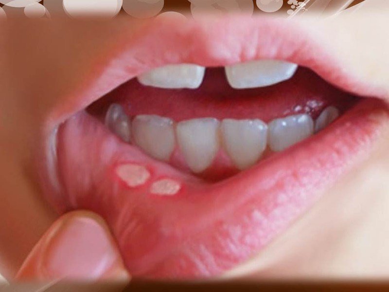 Стоматит у дітей в роті: симптоми, лікування в домашніх умовах афтозного та герпетичного стоматиту + ФОТО