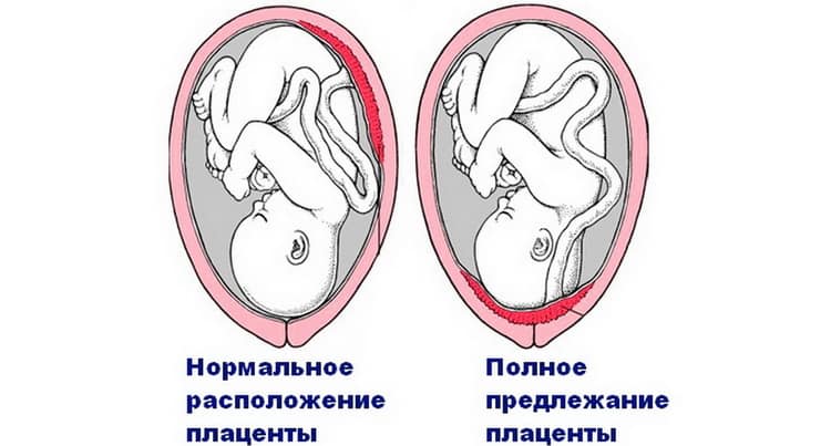 Крайове передлежання плаценти: симптоми, лікування