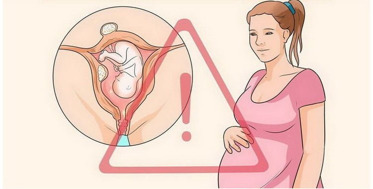 Міома матки при вагітності: чим загрожує