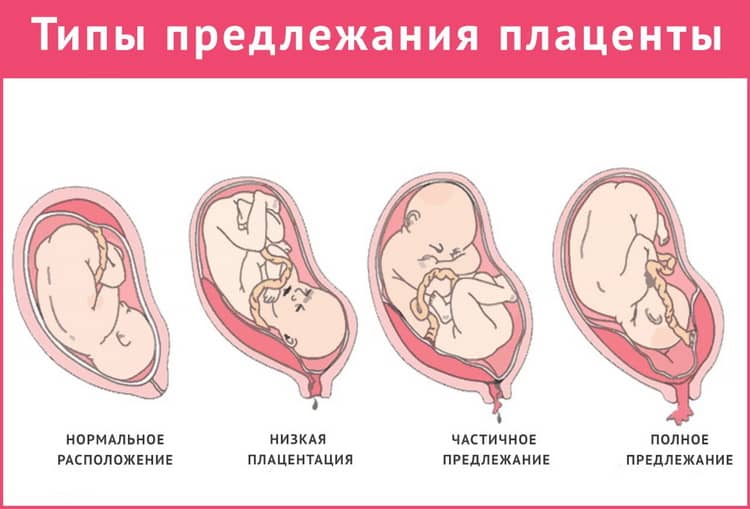 Плацента по передній стінці матки при вагітності