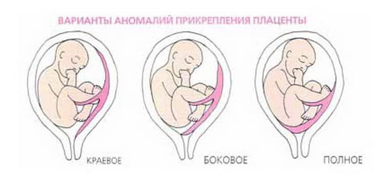 Плацента по передній стінці матки при вагітності