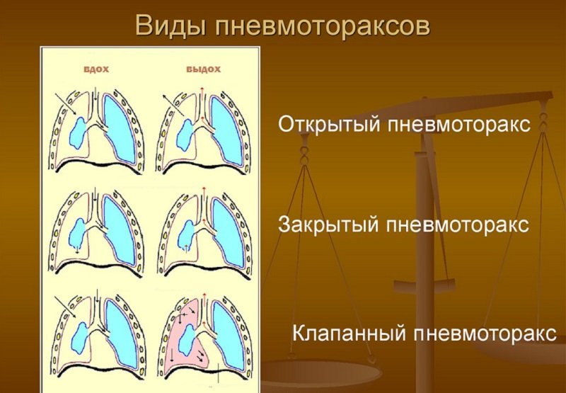 Пневмоторакс, його види та невідкладна долікарська допомога при пневматораксе